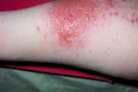 What poison ivy rash look like?